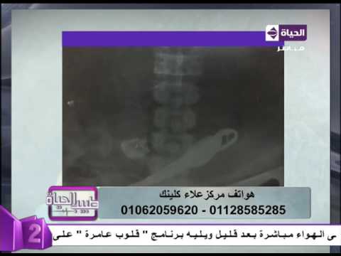 مريض يبلع شوكة ومقص بعد معايرة زوجته له بسبب مرضه الجنسي