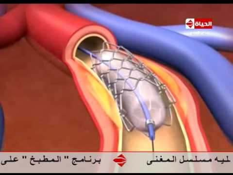 شاهد فيديو يوضّح كيفية عمل الاستعرضه برنامج العيادة عبر قناة الحياةدعامة التعويضية في القلب