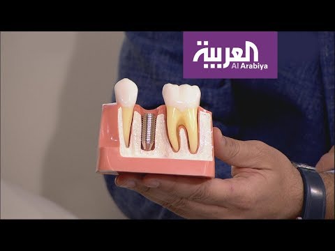 شاهد عرض حي وقصير لطريقة زراعة الأسنان