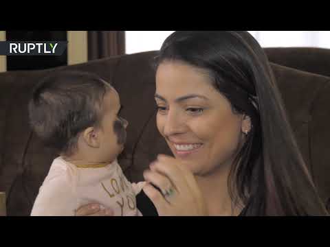 طفلة قناع باتمان الأميركية بعد أول عملية لإزالة الوحمة عن وجهها في روسيا