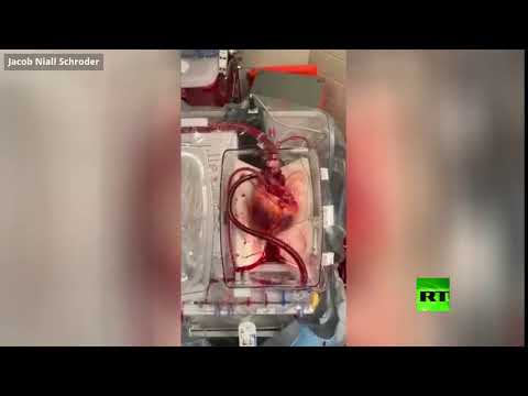 إعادة قلب ميت إلى الحياة للمرة الأولى في تاريخ الولايات المتحدة