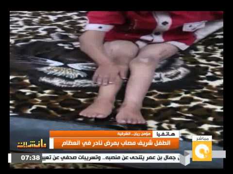 بالفيديو طفل يعاني من مرض نادر في العظام