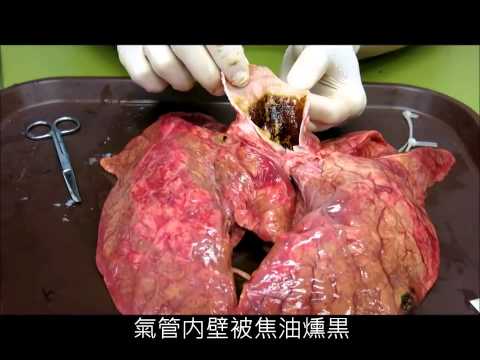 شاهد مدى تأثير تدخين 60 سيجارة فقط على الرئتين