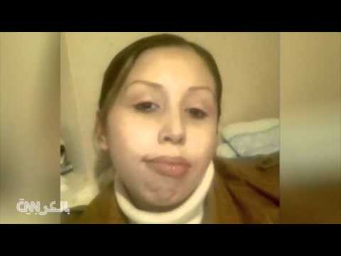 بالفيديو حالة نادرة لولادة طفل من رحم والدته الميتة