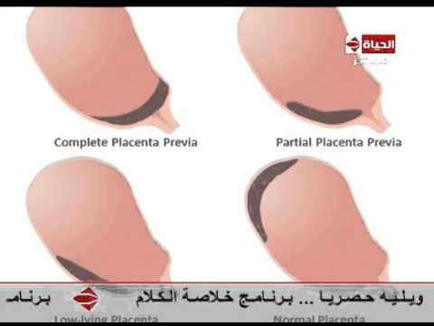 بالفيديو أسباب الولادة القيصرية