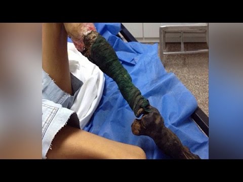 فيديو أخطر عضّة ثعبان في العالم